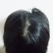 「頭頂部の薄毛に悩む日々」薄いてっぺんのお悩みに。女髪サプリ【ヘアドルーチェ】じっくり３ヵ月モニターの投稿画像