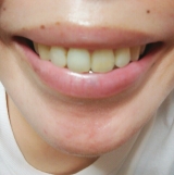 口コミ：ホワイトニングジェルで白い歯に♪の画像（1枚目）