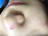 鼻の傷跡
