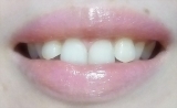 口コミ：結果報告★で、白くなったのか？～歯のホワイトニング　2の画像（3枚目）