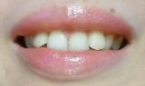 口コミ：結果報告★で、白くなったのか？～歯のホワイトニング　2の画像（2枚目）