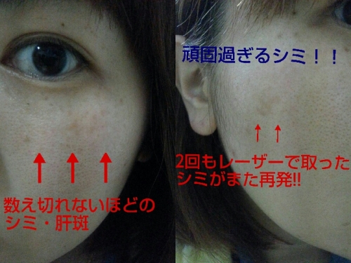 こんなシミ隠したいです画像募集 デルミサ レーザーコンシーラーの投稿 あや母さんさん