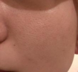 口コミ：おとなの毛穴ケアブランド『アンサージュ』～２ヶ月後のお肌～の画像（8枚目）