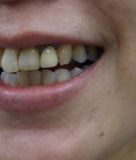 「歯茎の下がり」の画像