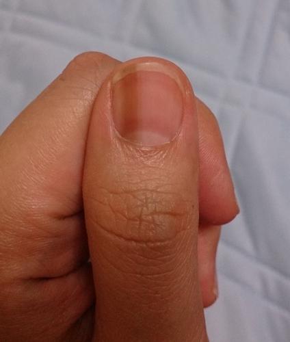 左手親指と両足小指の画像（2枚目）
