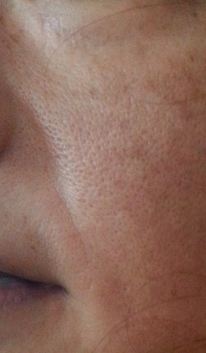 頬のたるみ毛穴とほうれい線の画像（1枚目）