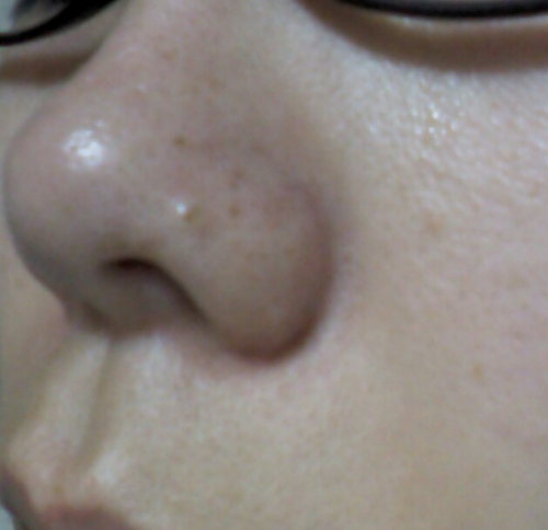 鼻のシミの画像（1枚目）
