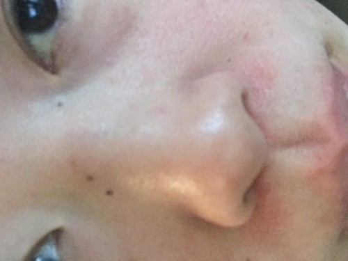 オリーブオイルで鼻の角栓ケアの画像（1枚目）