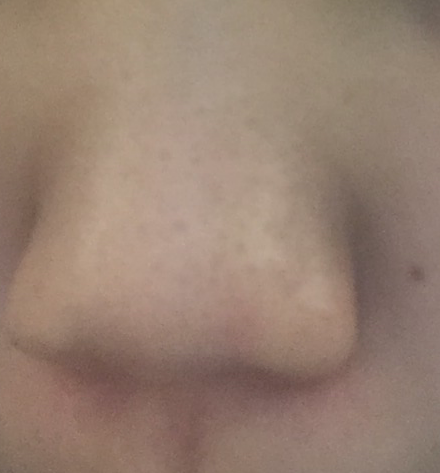 黒ずんでいる鼻の画像（1枚目）