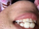 「歯の黄ばみが、、」の画像