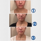 口コミ：続けて1週間！リフトアップ‼︎FinaLift②｜りらさんのブログの画像（2枚目）