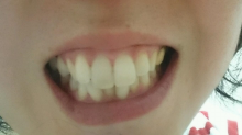 口コミ：
  使って１か月、ころころ歯ぶらし効果で健康ピンク♪
の画像（7枚目）