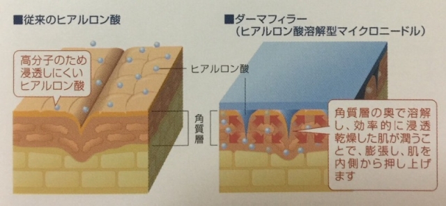 口コミ：ヒアルロン酸を角質層の奥に注入する新感覚「クオニス ダーマフィラー」♡の画像（3枚目）