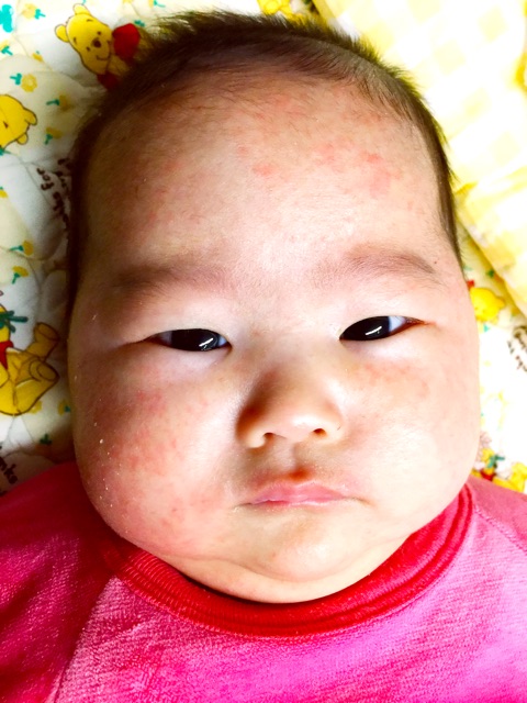 口コミ：生後2ヶ月　乳児湿疹に悩む( ;∀;)　赤ちゃんの肌を守る「アトピコ」の画像（12枚目）