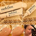 赤ニキビのケアをしてくれる薬用ホワイトニングクリームメディアクネを使ってみました。私は皮脂多め、部分的に乾燥する、若い頃ニキビに悩まされたのに、今でもできやすいめんどくさいタイ…のInstagram画像