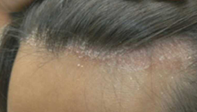 脂漏性皮膚炎部位の画像（1枚目）