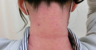 脂漏性皮膚炎部位の画像（2枚目）