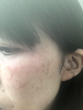 「BIRAI脂漏性皮膚炎用化粧水で悩み改善♡」の画像（1枚目）