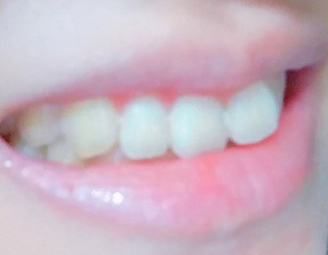 口コミ：薬用ホワイトニング　デンタウォッシュで歯が白くなった！の画像（3枚目）