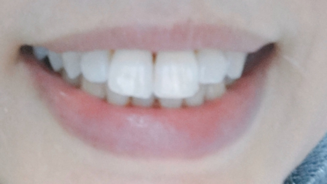 口コミ：歯のくすみが気になりホームホワイトニングの画像（3枚目）