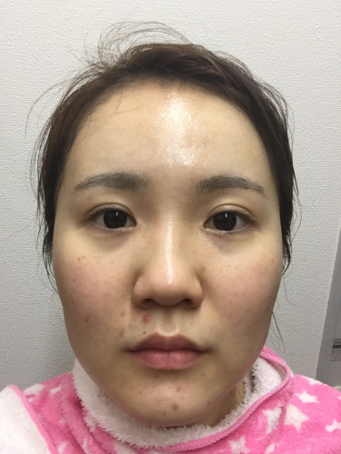 ほっぺ ニキビ 大きい
