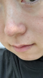 「鼻の下のニキビ跡がずっと消えなくて黒ずんでいます。」の画像（1枚目）