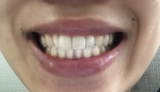 使用前の歯の状態