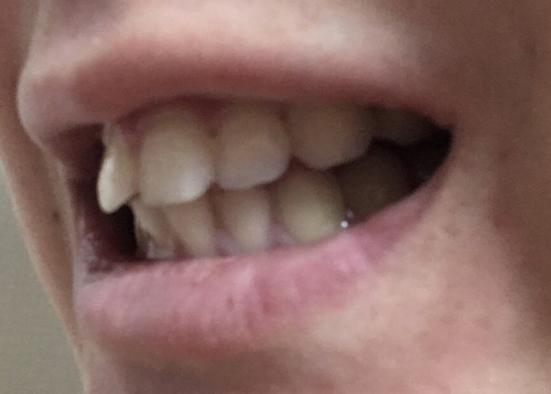 白い歯になりたい！の画像（1枚目）