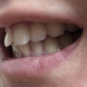 白い歯になりたい！