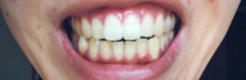 歯の画像（1枚目）