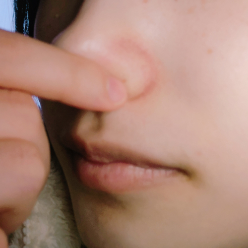小鼻と頬の毛穴の画像（1枚目）