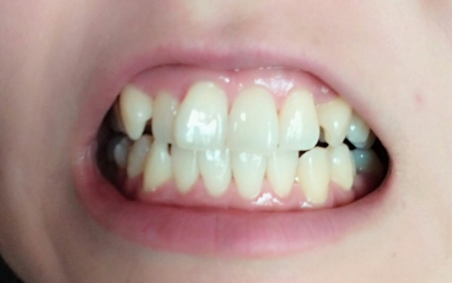 美白歯磨きジェルを一か月使用してみた結果の画像（2枚目）