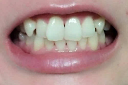 美白歯磨きジェルを一か月使用してみた結果の画像（1枚目）