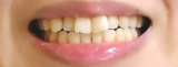 「歯のホワイトニング」の画像（1枚目）