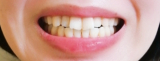 「歯のホワイトニング」の画像（2枚目）