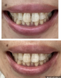 「忖度なし！　歯の白さを求めて1か月　結果発表」の画像（1枚目）