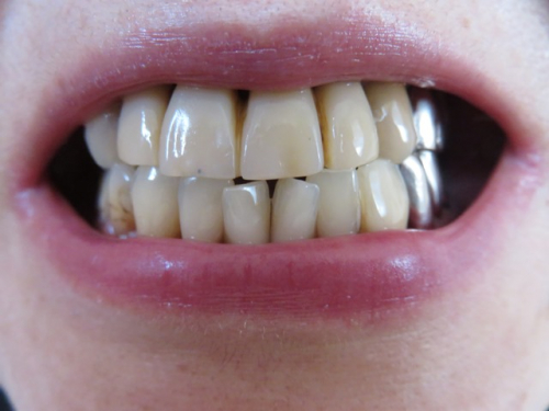1か月使用の歯のビフォーアフターの画像（2枚目）