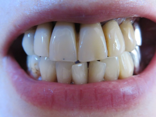 1か月使用の歯のビフォーアフターの画像（1枚目）