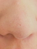 「綺麗になった小鼻と頬」の画像（1枚目）