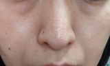 小鼻の毛穴