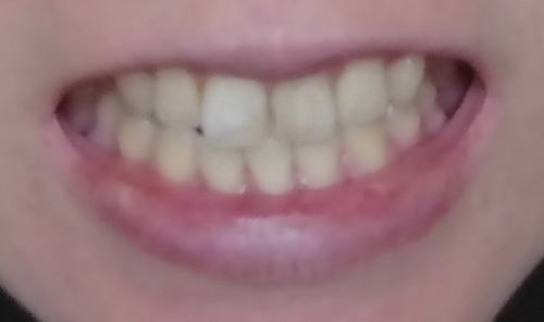 歯の美白ケアの画像（2枚目）