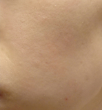 頬にある大人ニキビと乾燥による肌荒れとくすみに悩んでいます