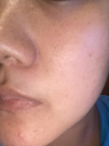 鼻の毛穴と頬のシミ
