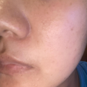 鼻の毛穴と頬のシミ