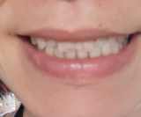 「前歯のきばみ」の画像（1枚目）