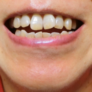 「白い歯になりたい！」【新商品】美白歯みがきジェルを使って画像投稿をしてくれる方30名募集★の投稿画像
