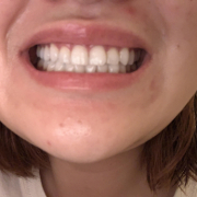 「白い歯になりたい」【新商品】美白歯みがきジェルを使って画像投稿をしてくれる方30名募集★の投稿画像