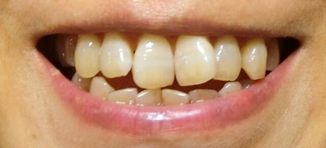 口コミ：xivaシーヴァ　 薬用ホワイトニング デンタブラッシュEX これ1本で健やかな美白歯の画像（15枚目）