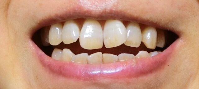 口コミ：xivaシーヴァ　 薬用ホワイトニング デンタブラッシュEX これ1本で健やかな美白歯の画像（16枚目）