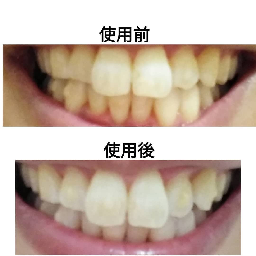 口コミ投稿：シーヴァ　デンタブラッシュEXマウスピース矯正をしています。歯の黄ばみが気になっ…